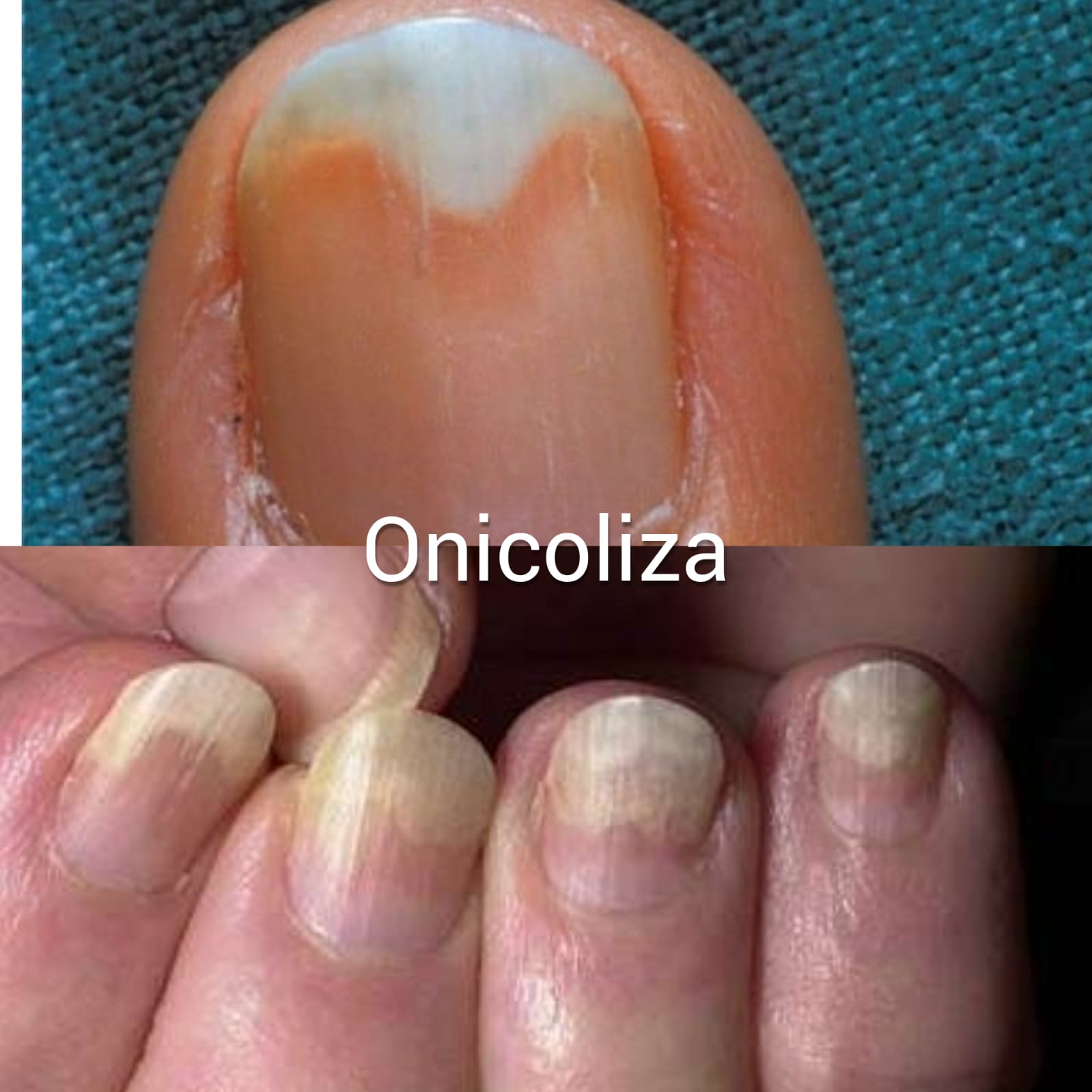 tratamentul onicolizei ciupercii unghiilor