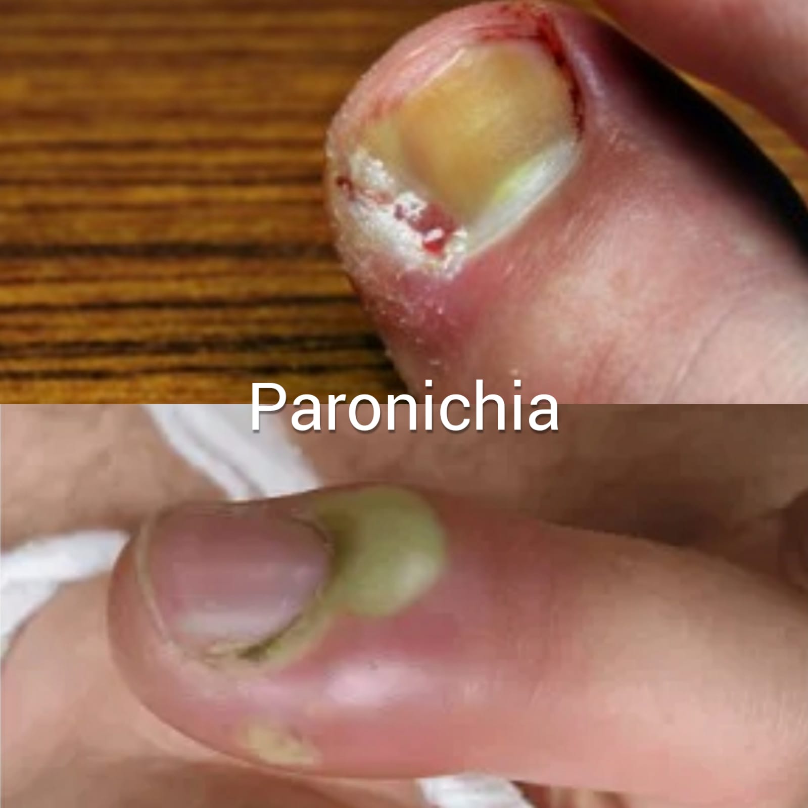 ciuperca pe unghii Pseudomonas aeruginosa pe unghii ciuperca unghiilor cum să dezinfectați șosete