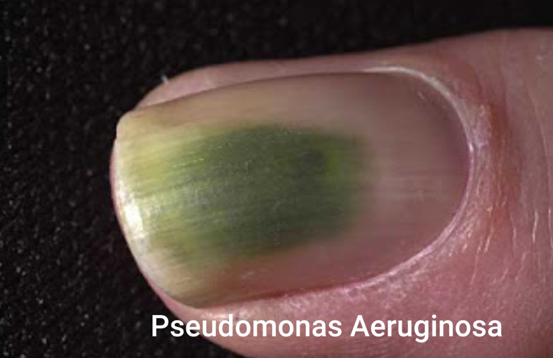 ciuperca pe unghii Pseudomonas aeruginosa pe unghii)